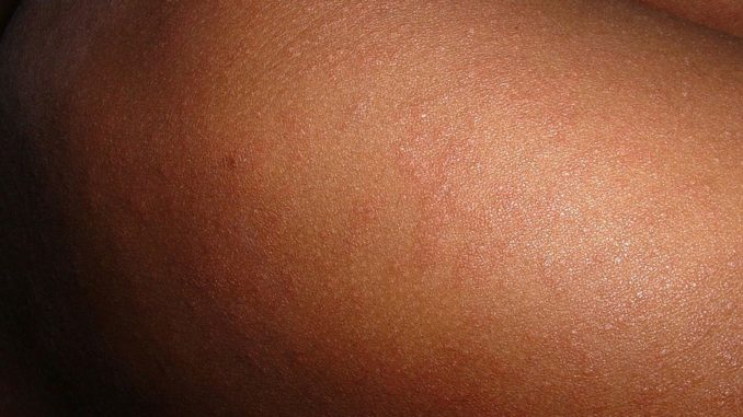 measles-648479_960_720